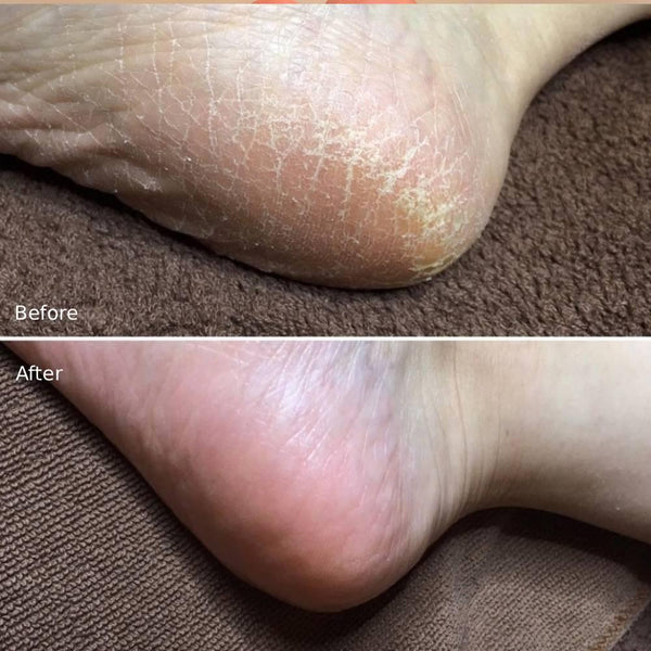 Liberta-Baby-Foot-Exfoliation-Foot-Peal-for-Men-60-Minutes-Treatment-5-2025-08-20T06:40:37.172Z.jpg