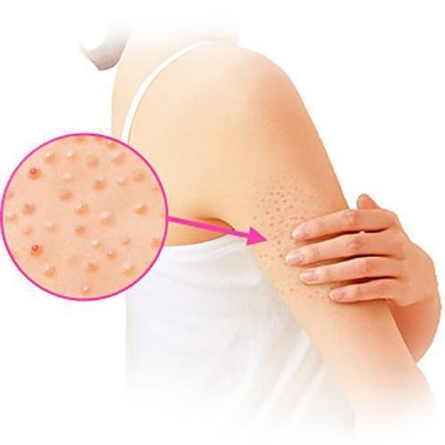 P-2-KBY-NIN-CR-30-Kobayashi Nino Cure Medicated Cream for Keratosis Pilaris 30g.jpg
